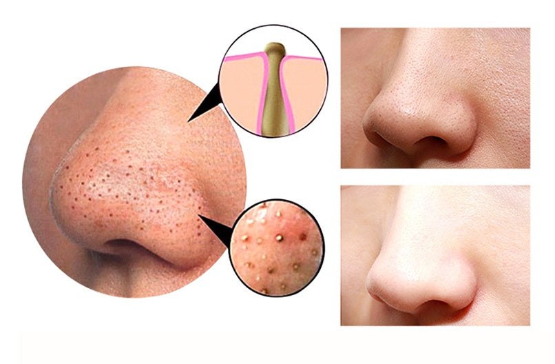 Apux Glow 1.0 [Blackhead Remover Machine]
